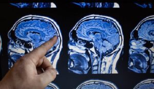 Mehr über den Artikel erfahren Marihuana Substanz entfernt giftige Alzheimer-Proteine