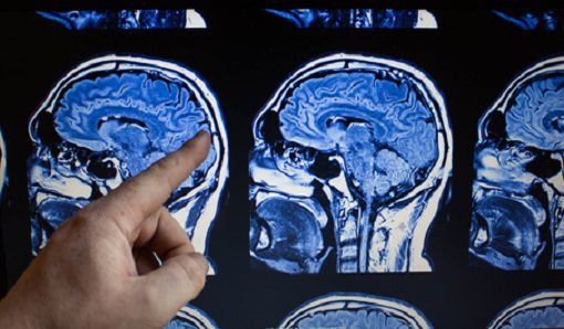 Marihuana Substanz entfernt giftige Alzheimer-Proteine