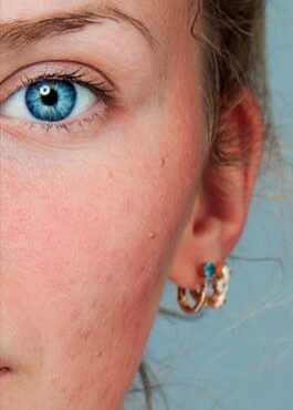 AKNE NACH ABSETZEN DER ANTIBABYPILLE?